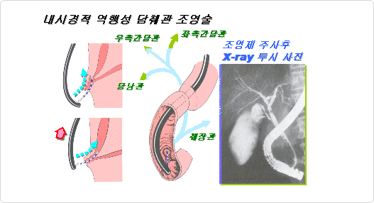내시경적 역행성 담췌관 조영술